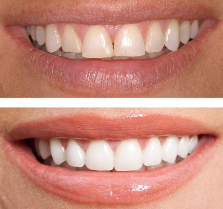 Teeth whiting, Doni Dent - Dental Clinic